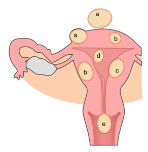 Miomas o fibromas uterinos