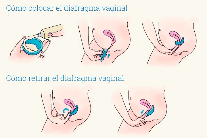 colocacion-diafragma-vaginal-ginesur